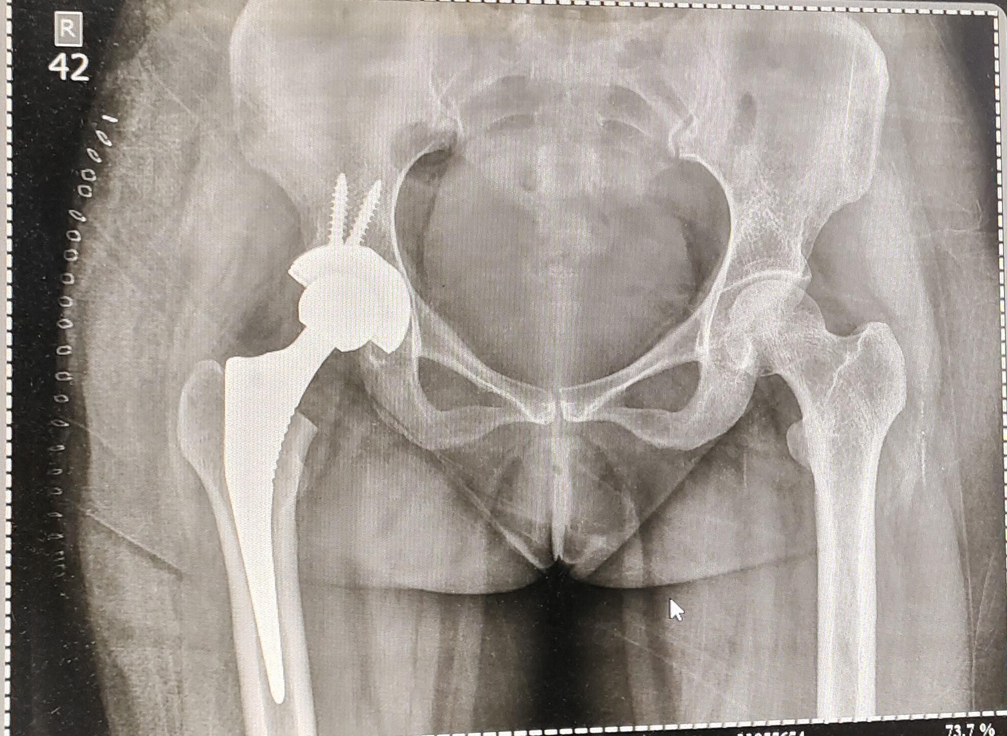 Total Hip Replacement