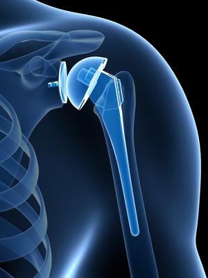 Total Shoulder Arthroplasty / Replacement