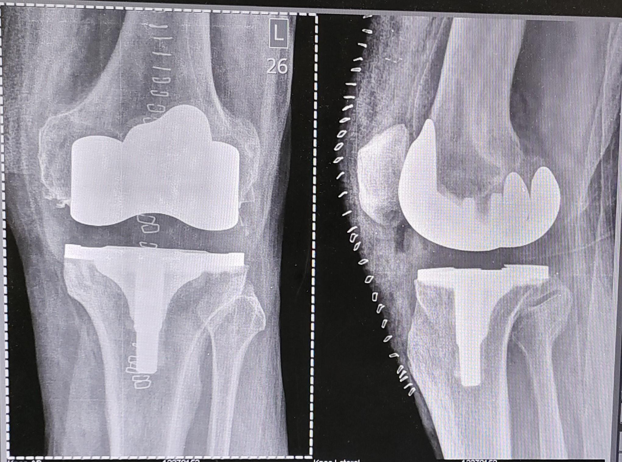 Total Knee Arthroplasty