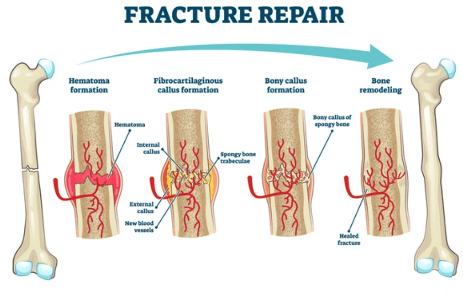  Fracture Treatment