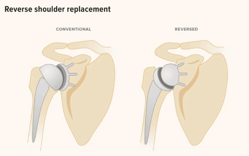 Reverse Shoulder Replacement / Arthroplasty 